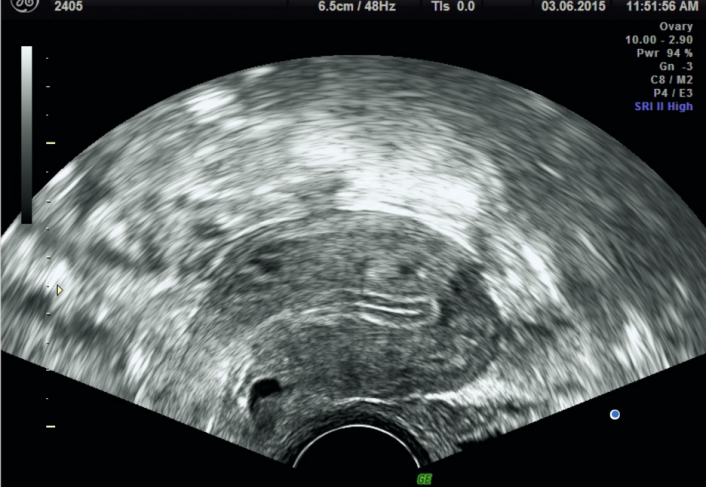 An ultrasound image of normal, healthy endometrium